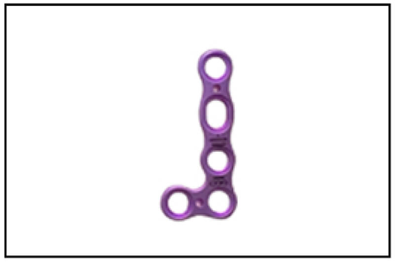 Extremity Plating System
