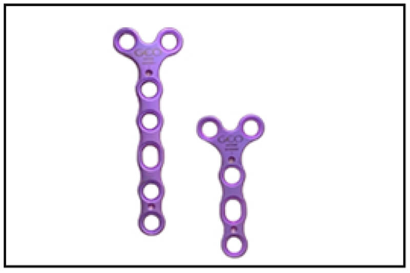 Extremity Plating System