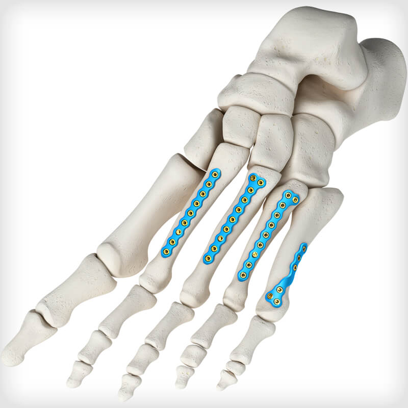 5th Metatarsal Spiral Fracture Plates