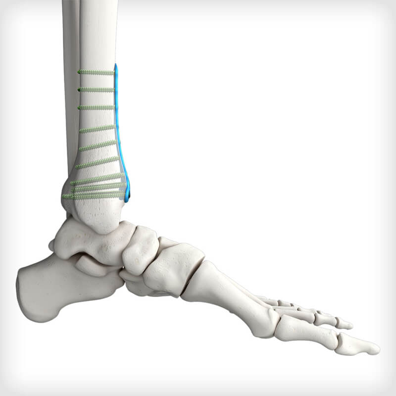 Anterior Distal Tibia Plates