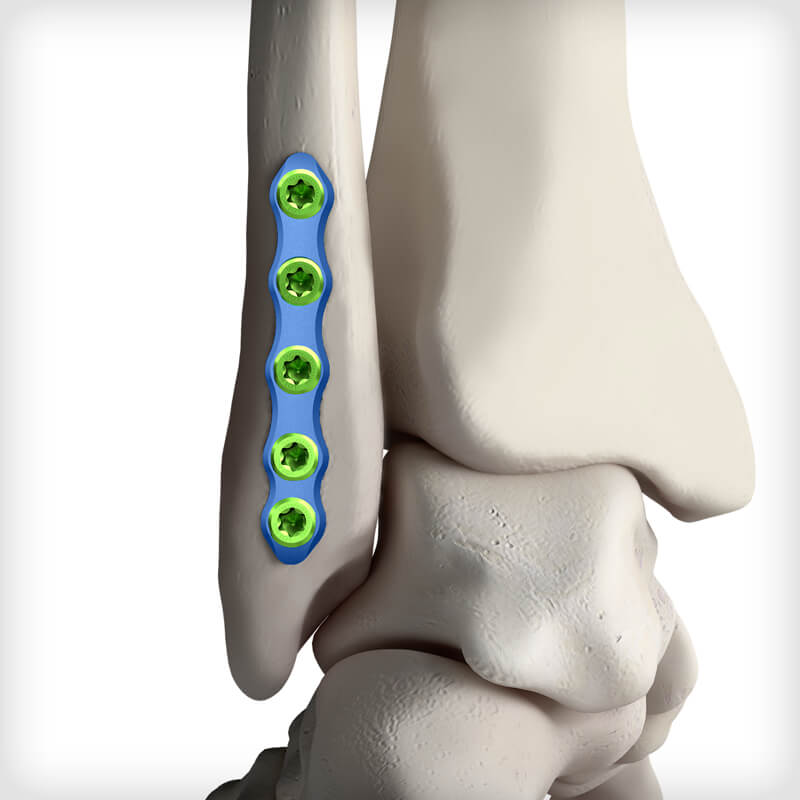 Flex Fibula Plates