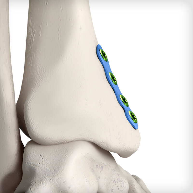Flex Fibula Plates