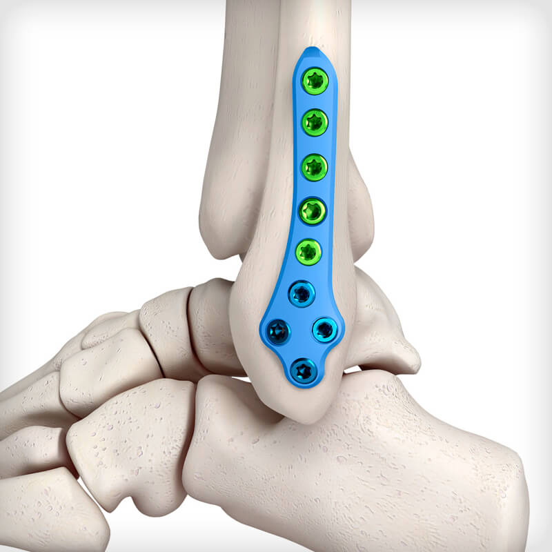 Lateral Fibula Plates