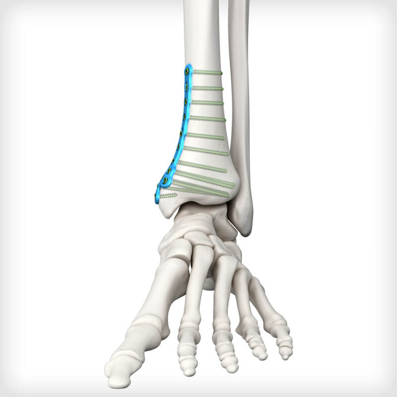 Medial Distal Tibia Plates