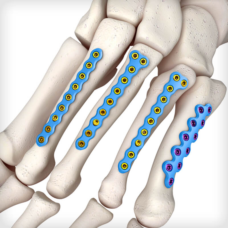 Metatarsal T Plates