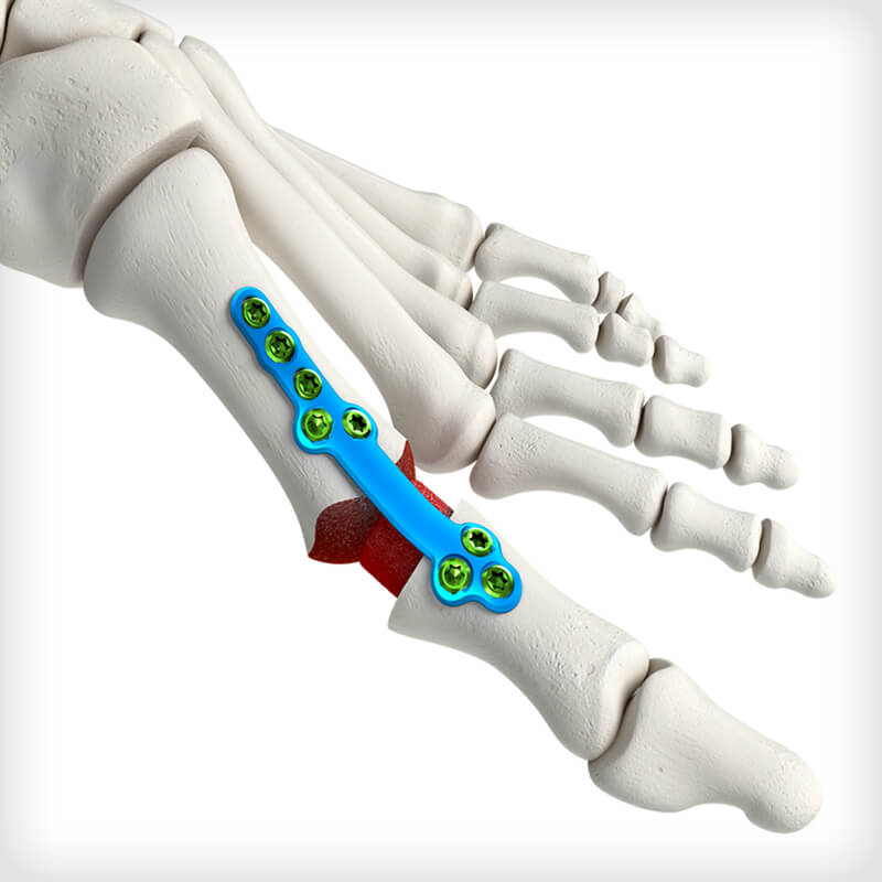 MTP Fusion Plates