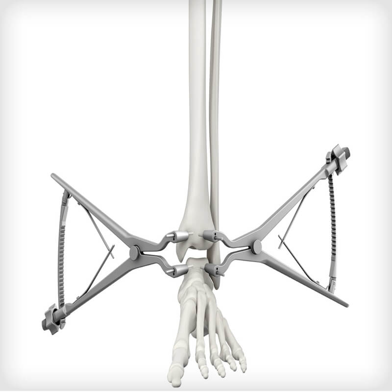 Pilon Primary Fusion Plates