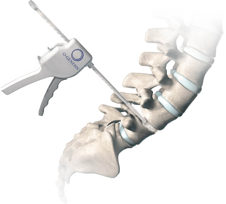 O-Genesis Graft Delivery